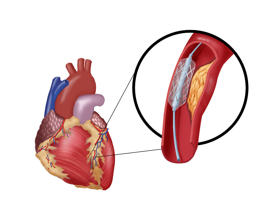 Angioplasty with Stenting,2 of 4