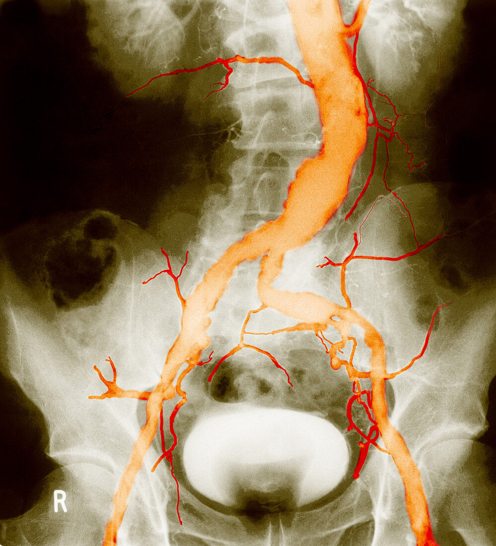 Atheroma in Aorta and Iliac Arteries