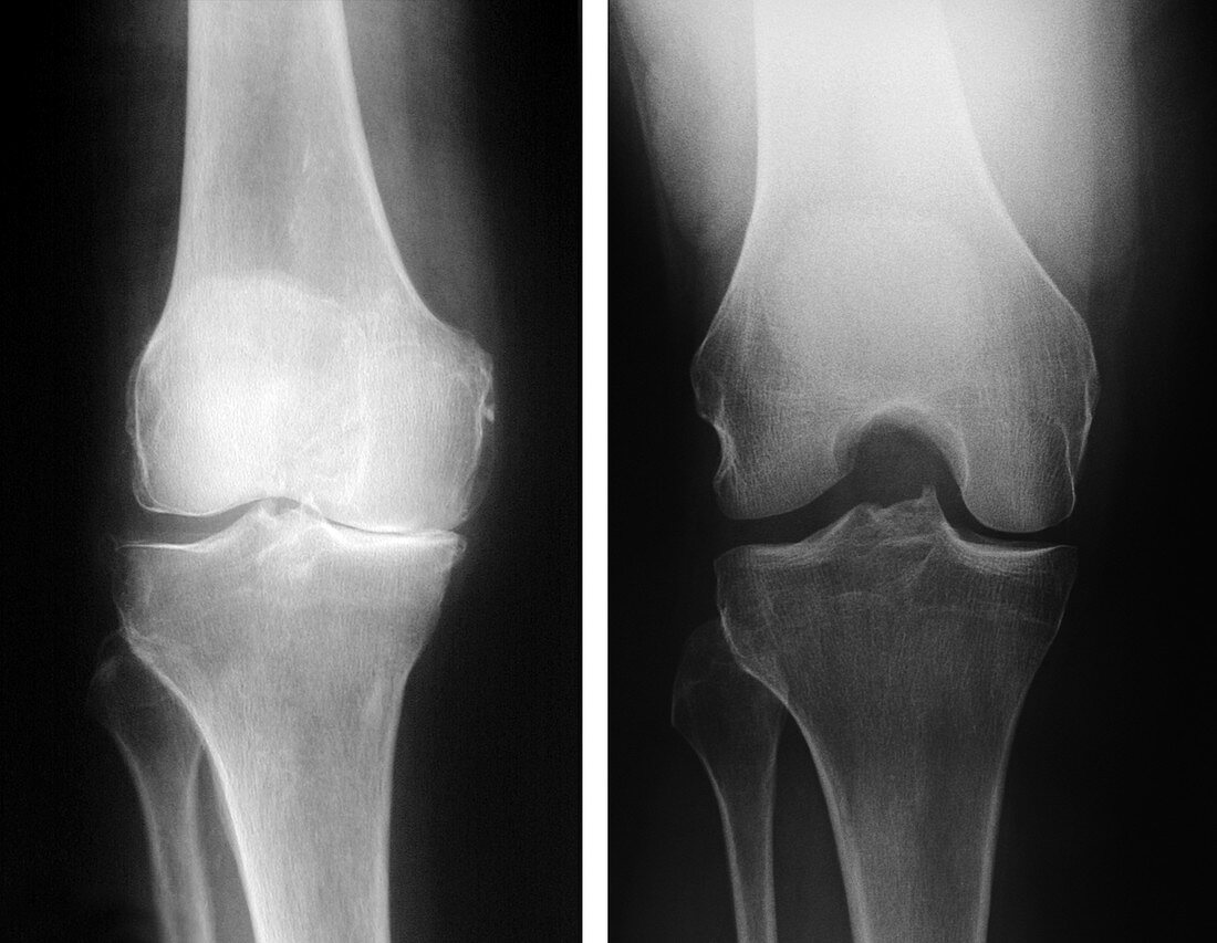 X-Rays of Normal and Degenerative Knees