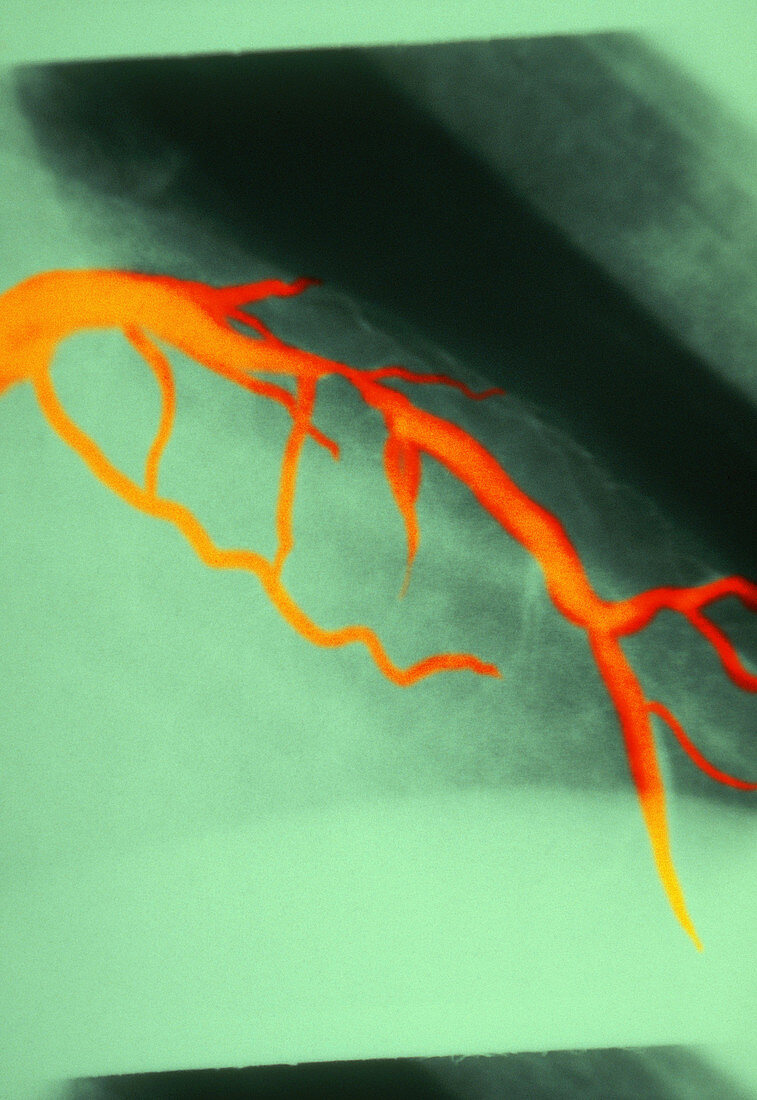 Narrowing in Coronary Artery (1 of 3)