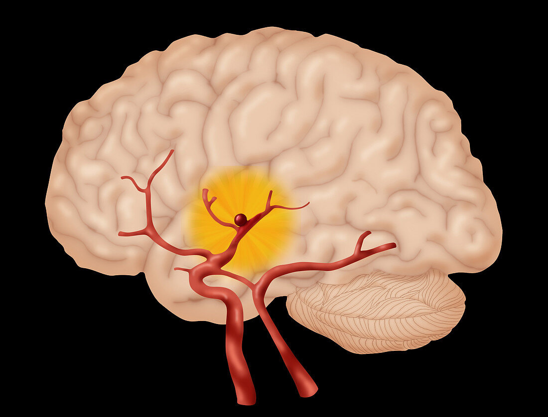 Brain Aneurysm,2 of 3