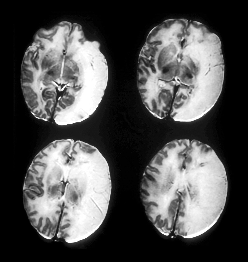 Large Infantile Stroke,MRI