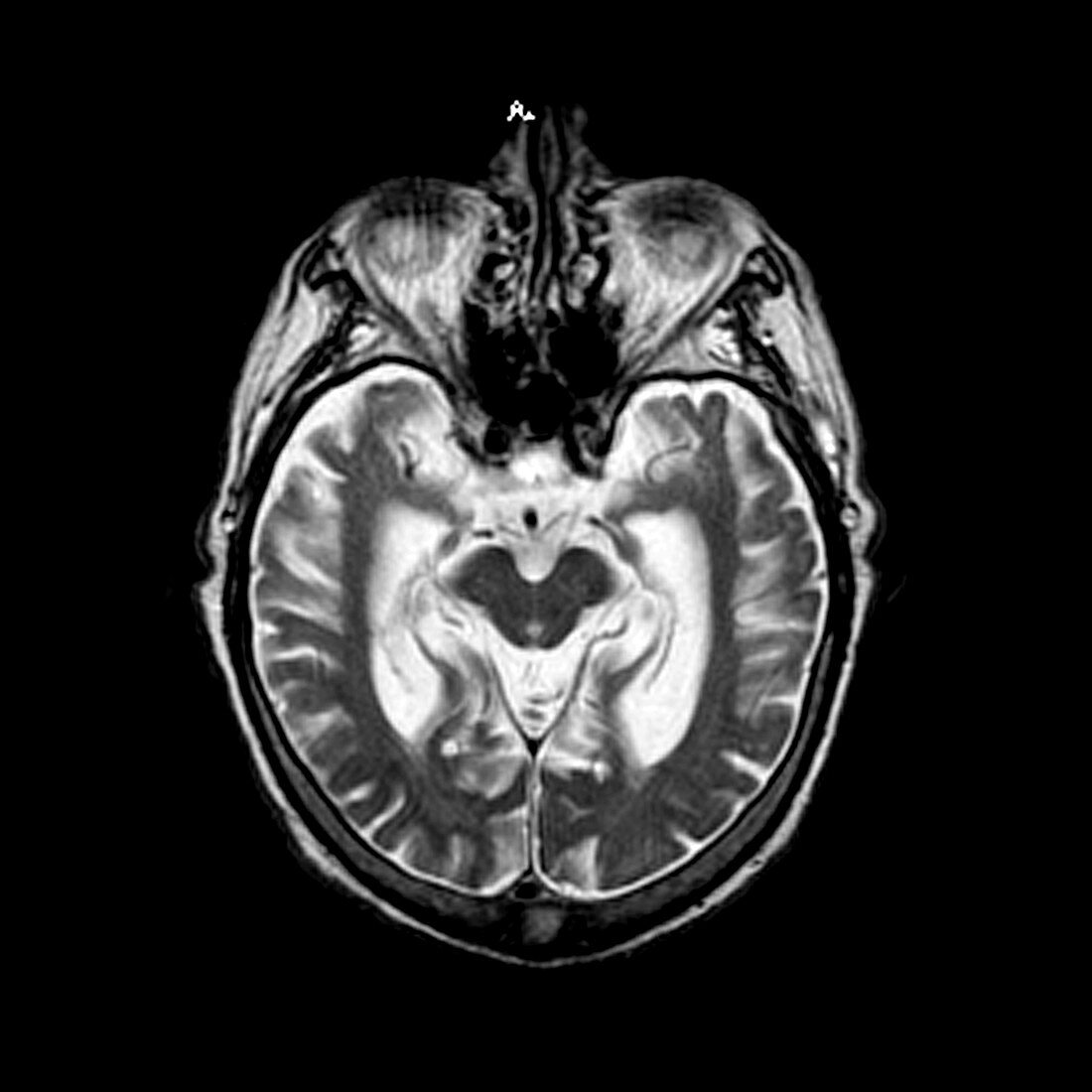 Alzheimer's Disease,MRI