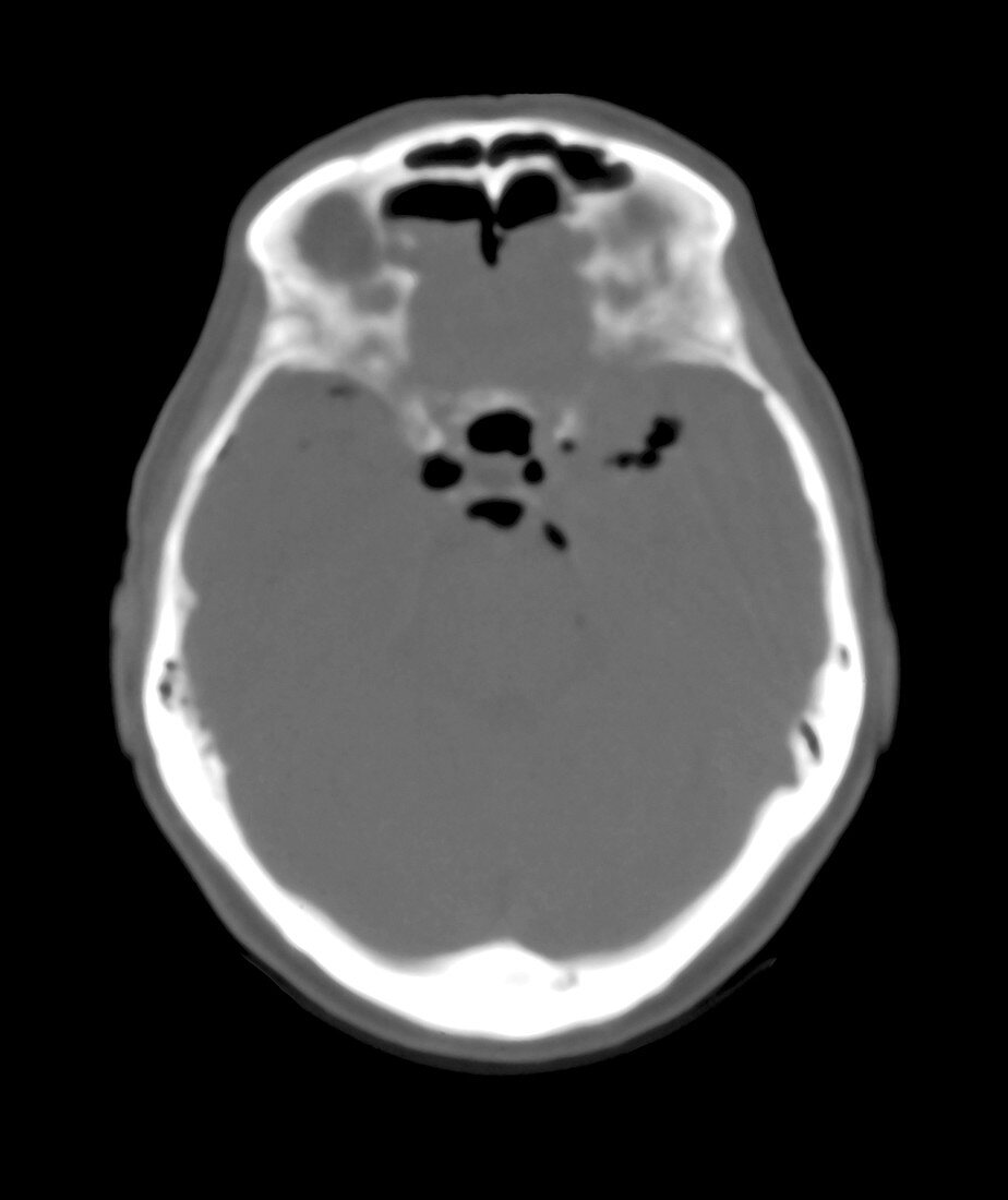 Post-Traumatic Pneumocephalus,CT