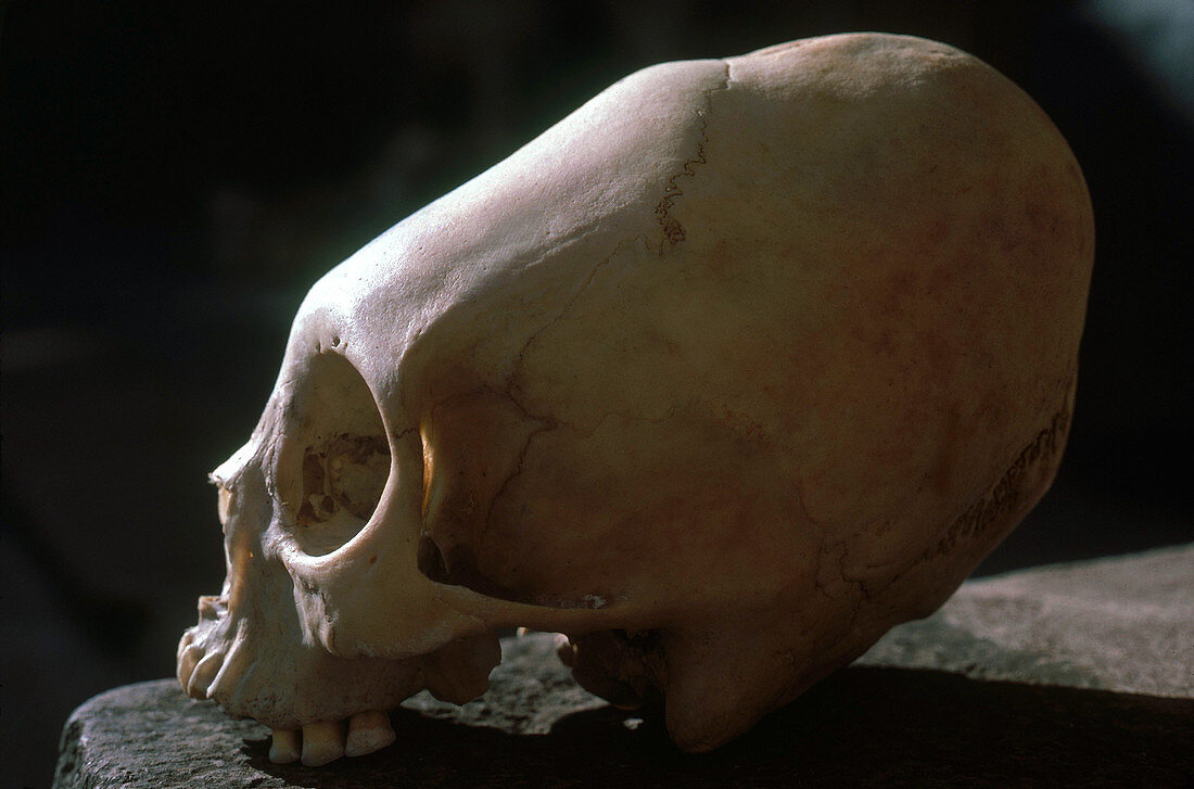 Deformed Incan Skull