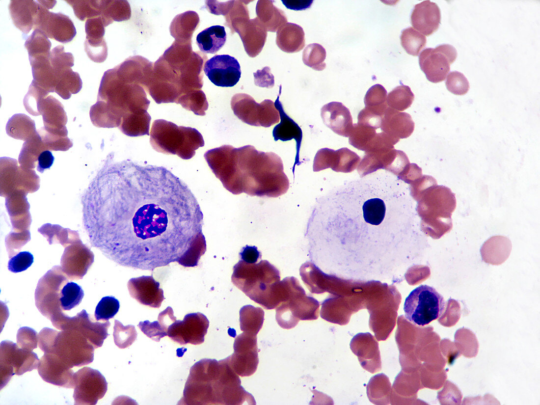Gaucher's Cells and Peripheral Blood (LM)