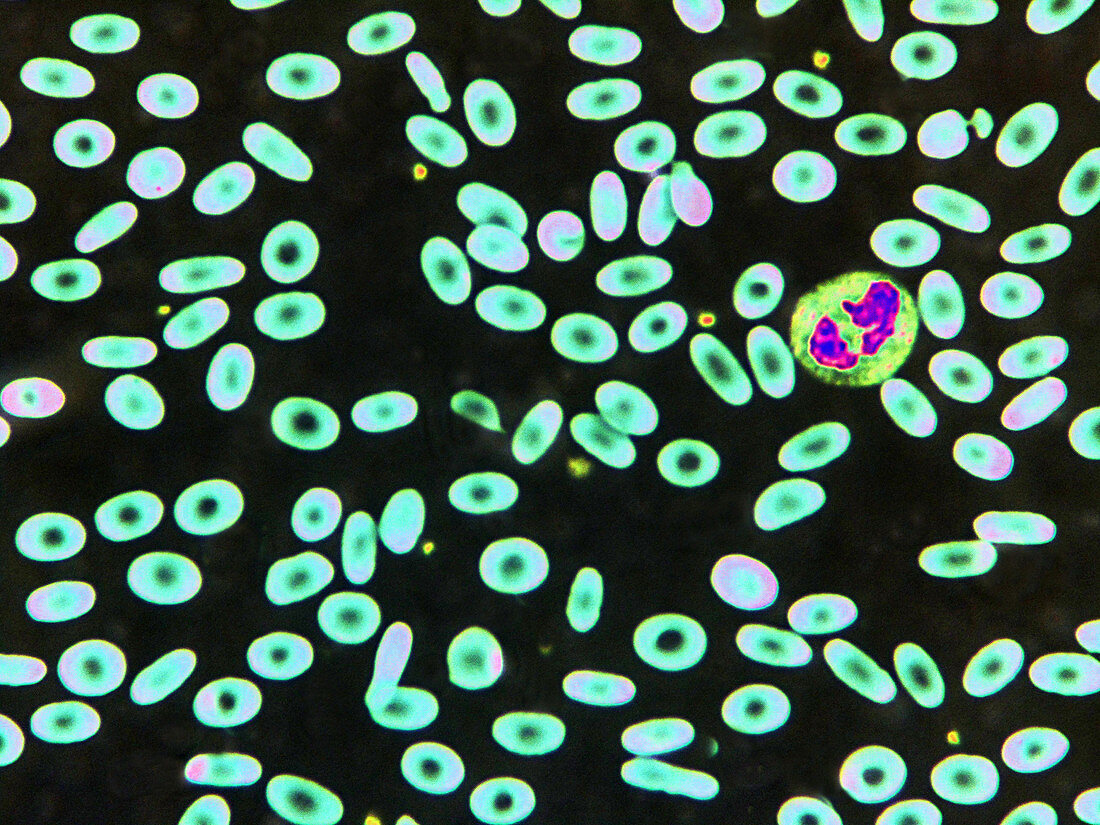 Ovalocytosis (LM)