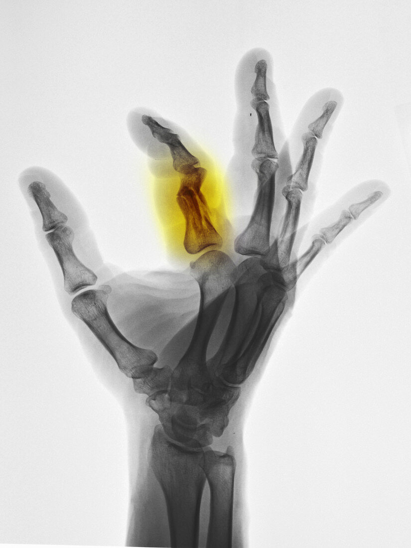 Broken Proximal Phalanx of Index Finger