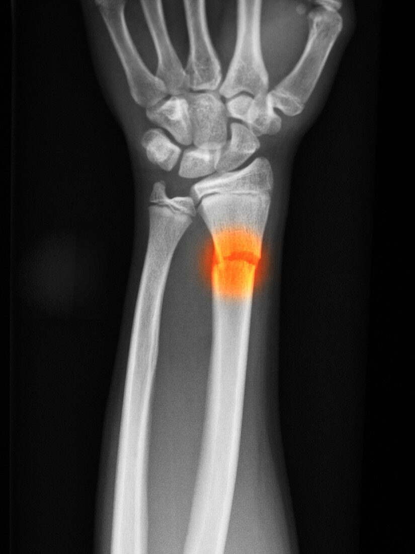 Distal Radius Fracture in a 14 Year Old B