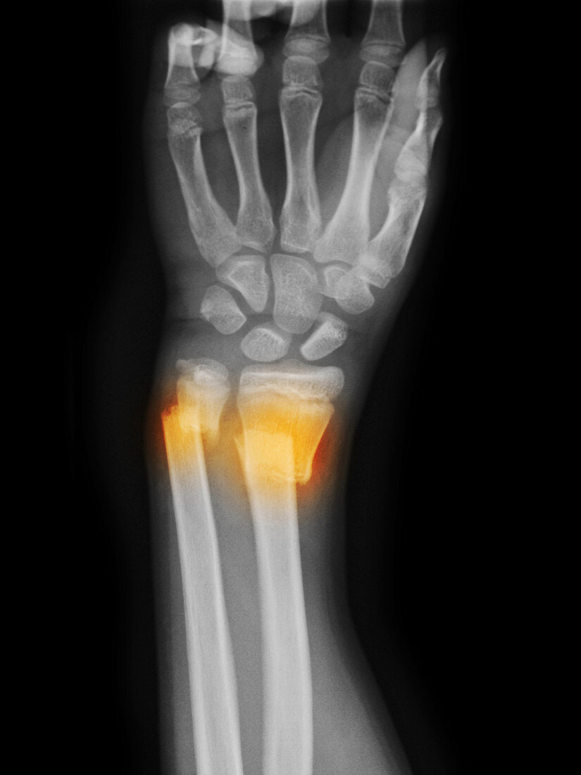 Distal Radius and Ulna Fracture with Disp