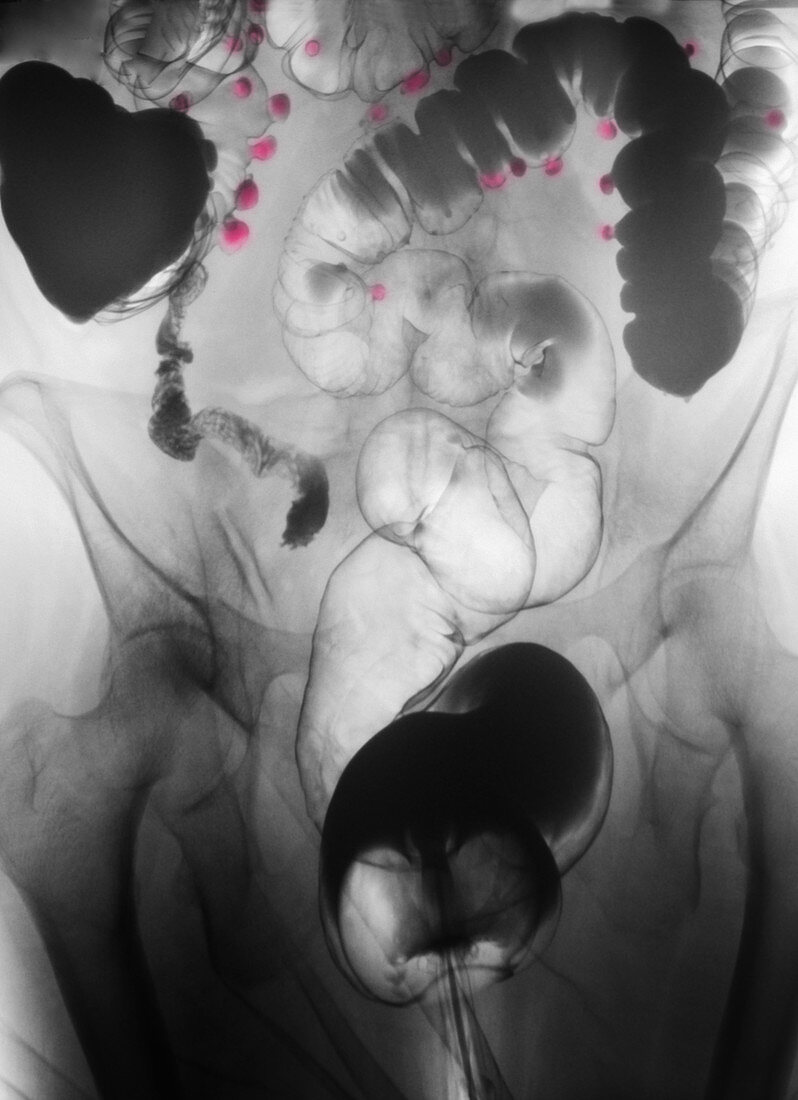 Diverticulosis of the Colon