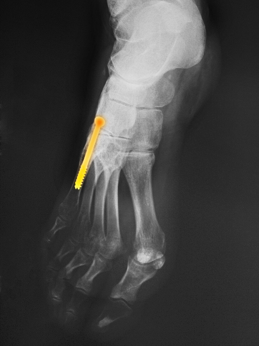 Post-Surgery Foot X-ray