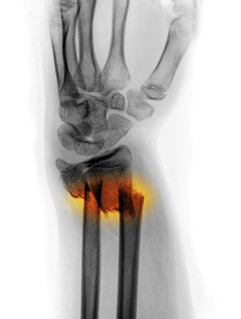 Forearm Fracture in a 12 Year Old Girl