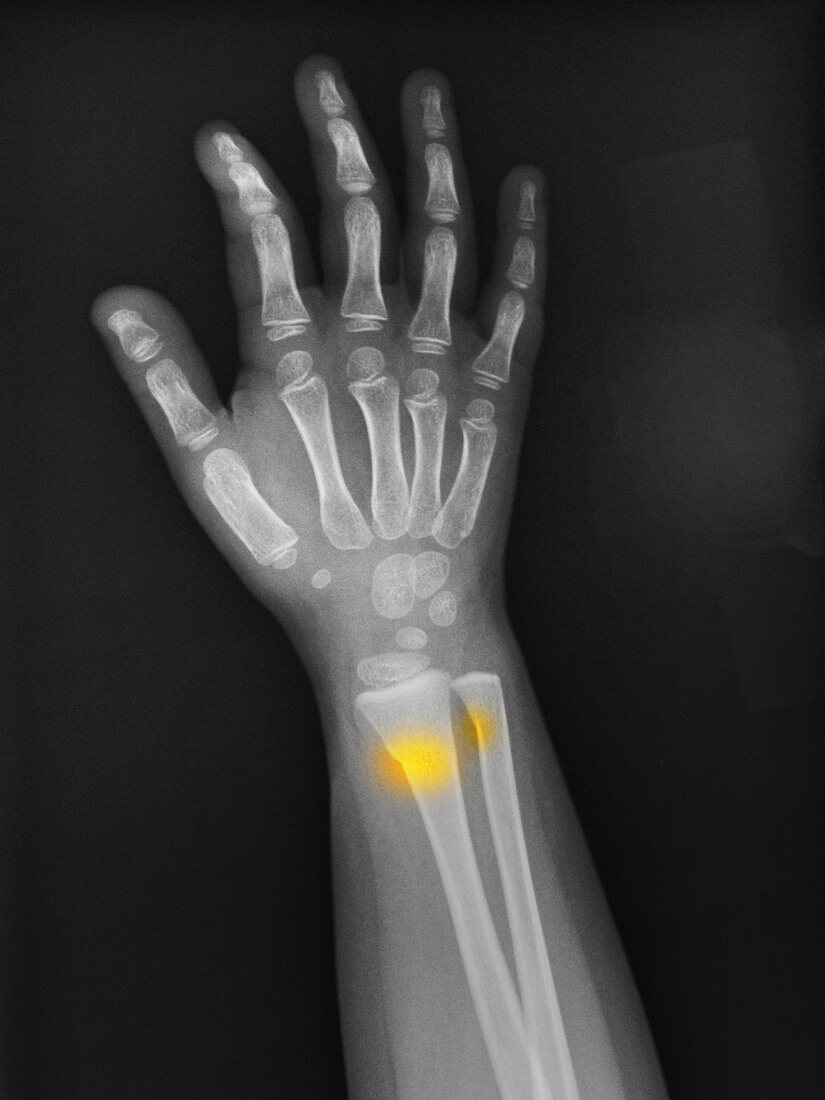 Greenstick Fracture in 3 Year Old Girl