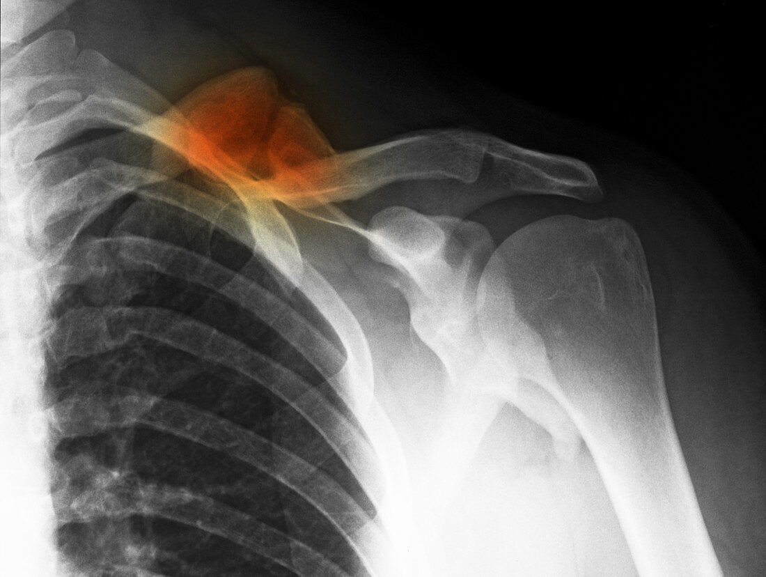 Healed Clavicle Fracture