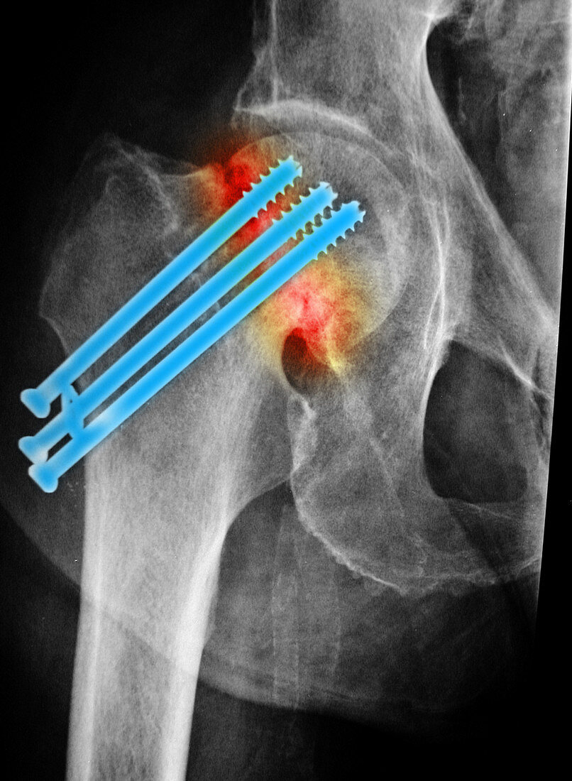 Repaired Hip Fracture