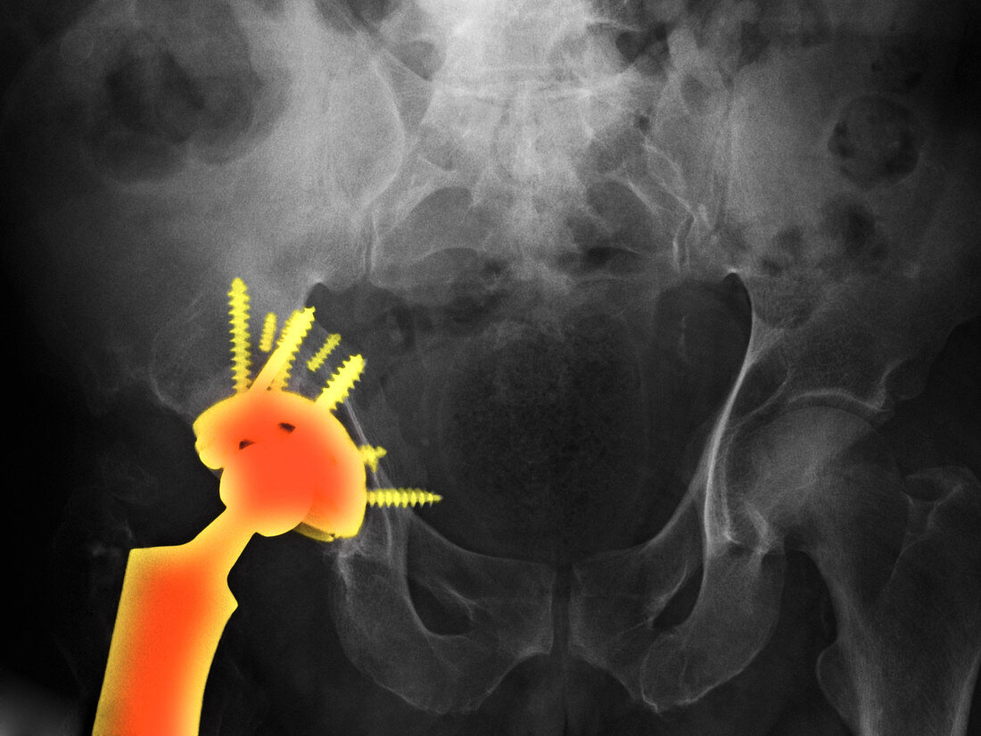 Dislocated Hip Replacement