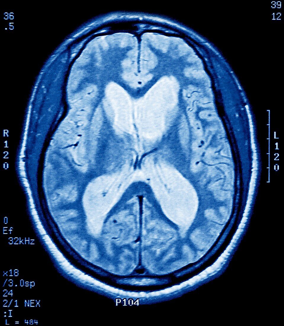 Alzheimer's disease,MRI brain scan