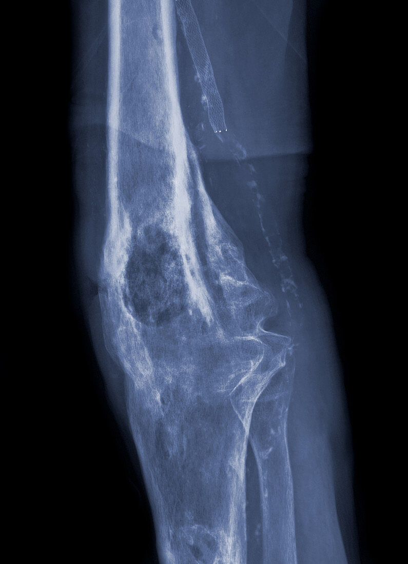 Osteomyelitis,Knee X-Ray
