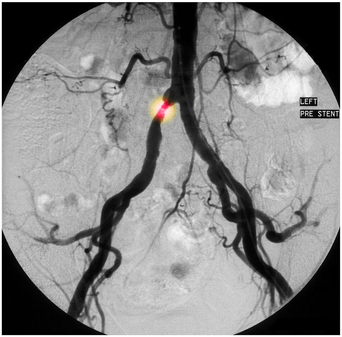 Stenosis in Common Iliac Artery (1 of 2)