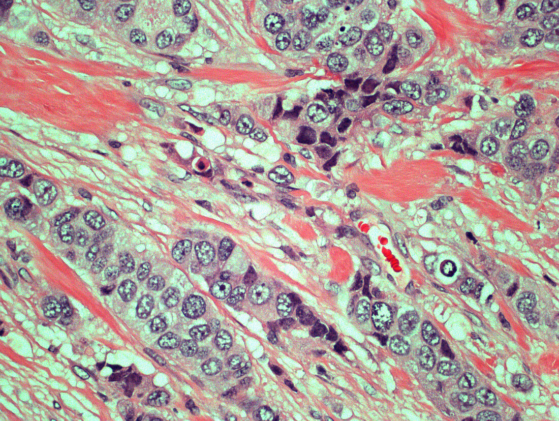 Invasive Ductal Carcinoma,LM