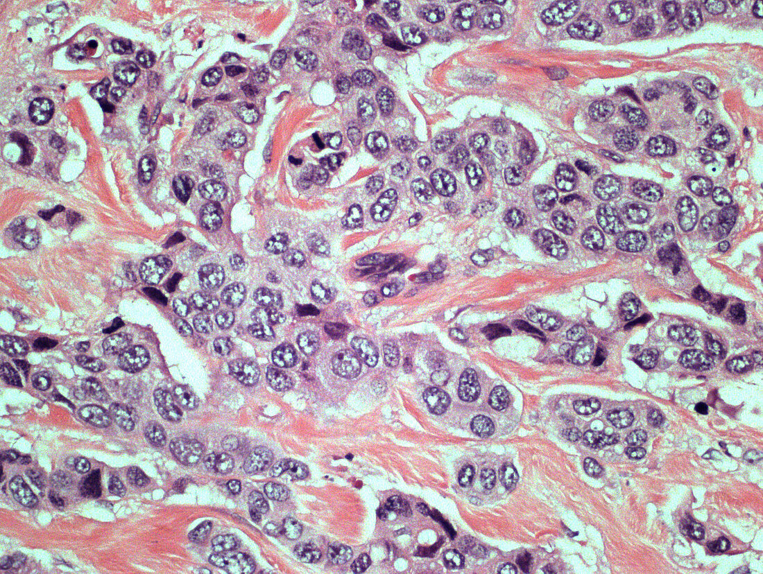 Invasive Ductal Carcinoma,LM