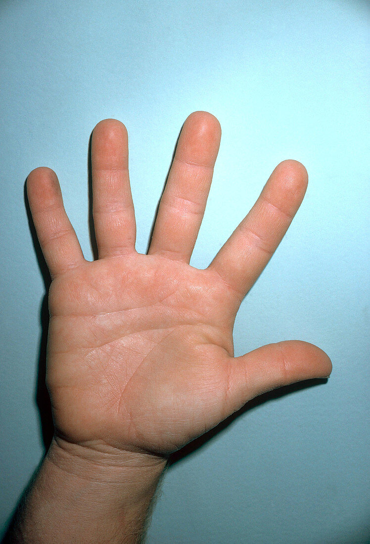Acromegalous Hand