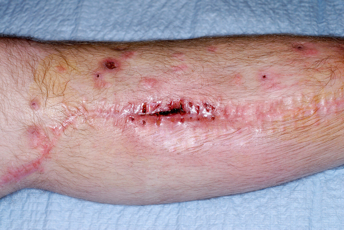 Healing Leg Wound
