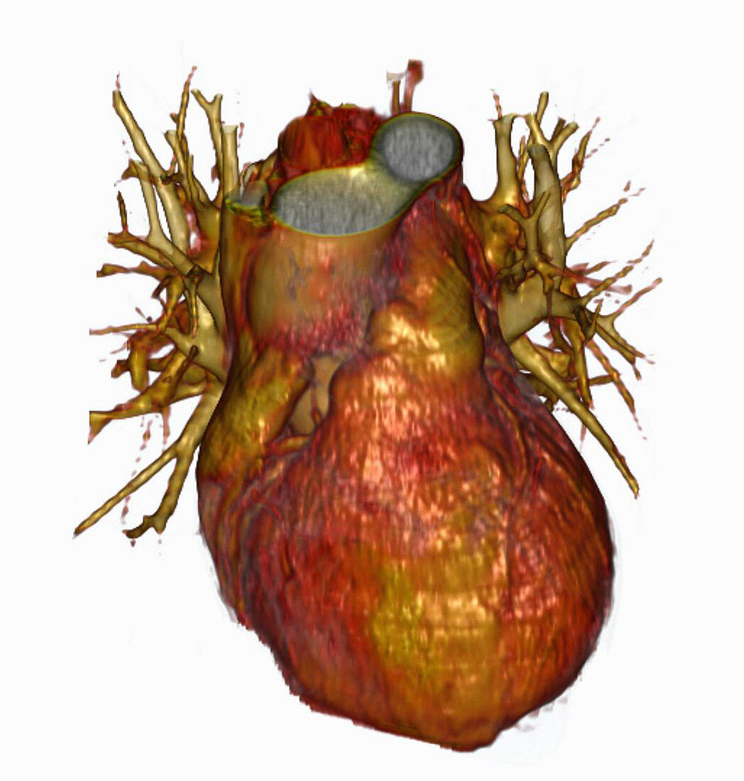 3D CT Scan of Heart
