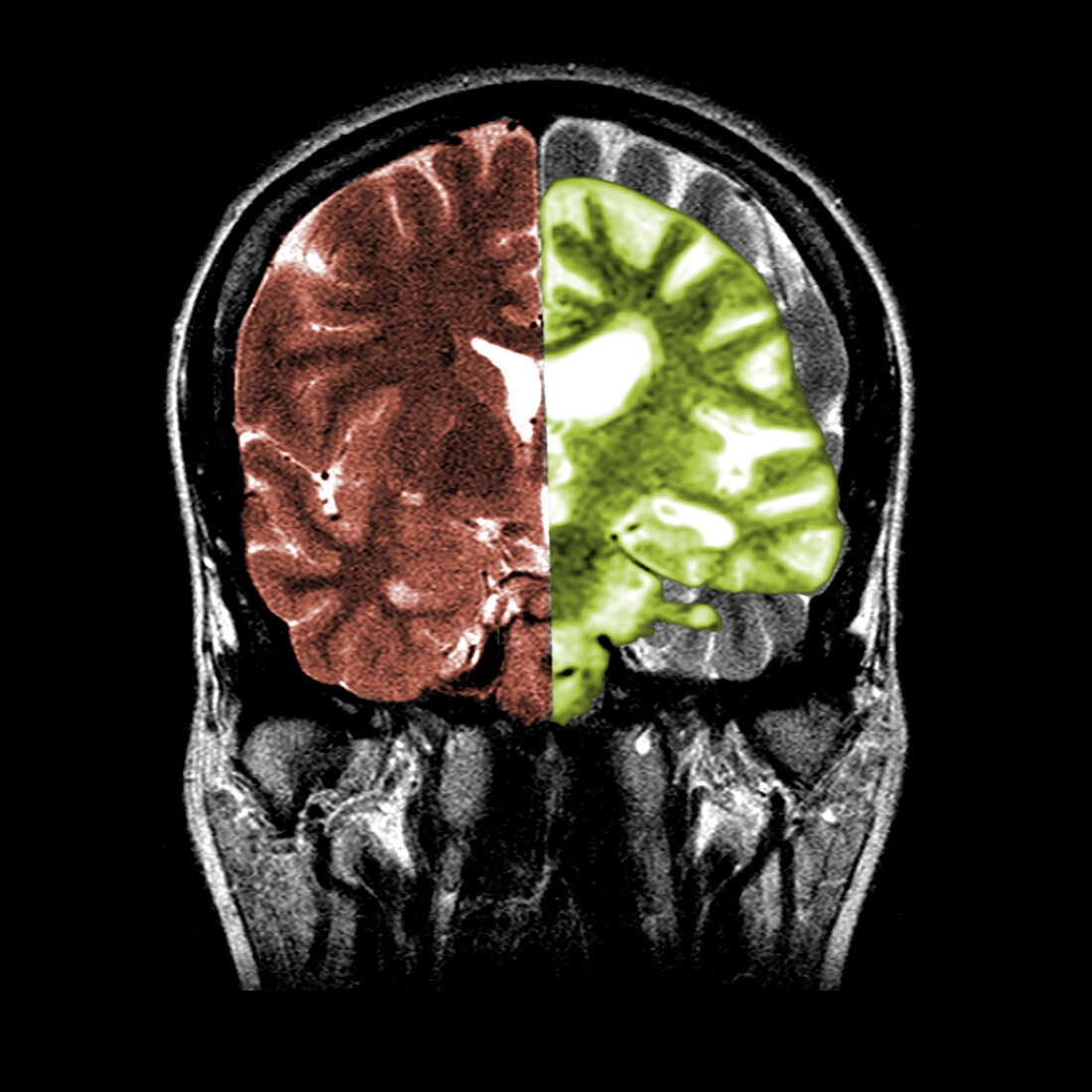 Normal and Alzheimer's Brain MRIs
