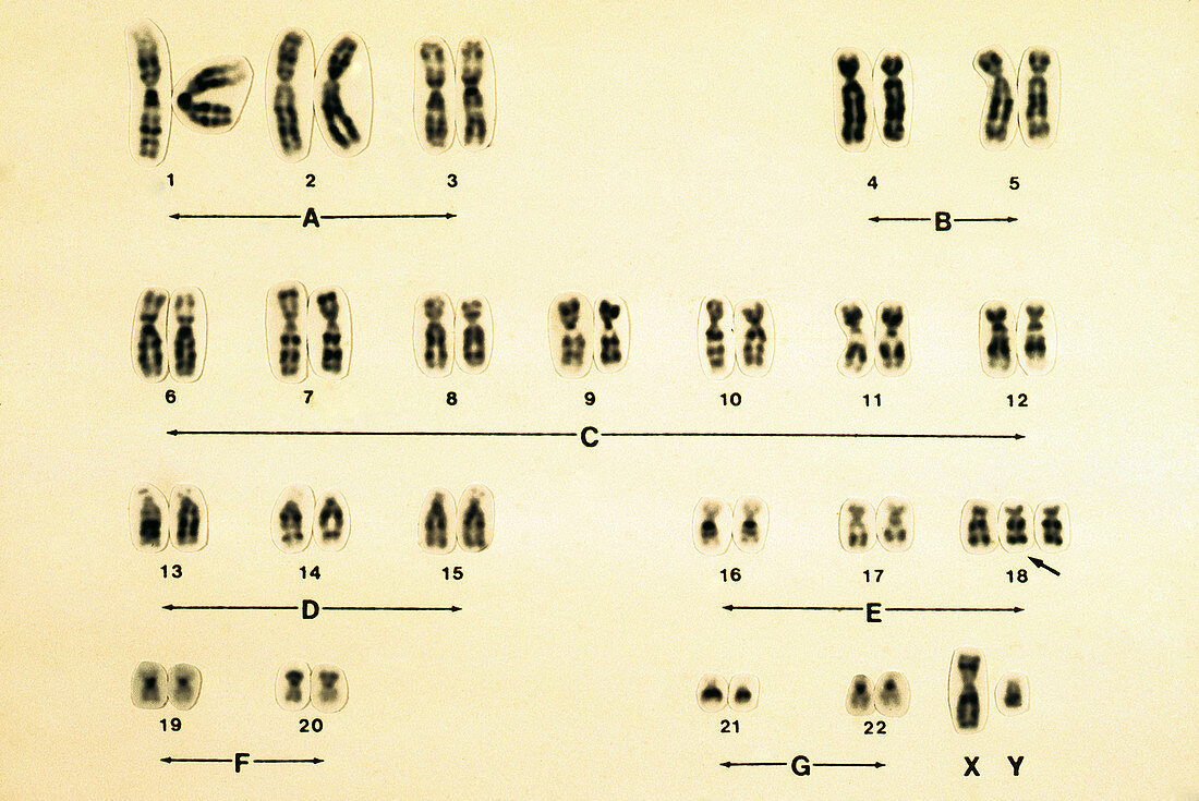 Male Karyotype with Trisomy 13