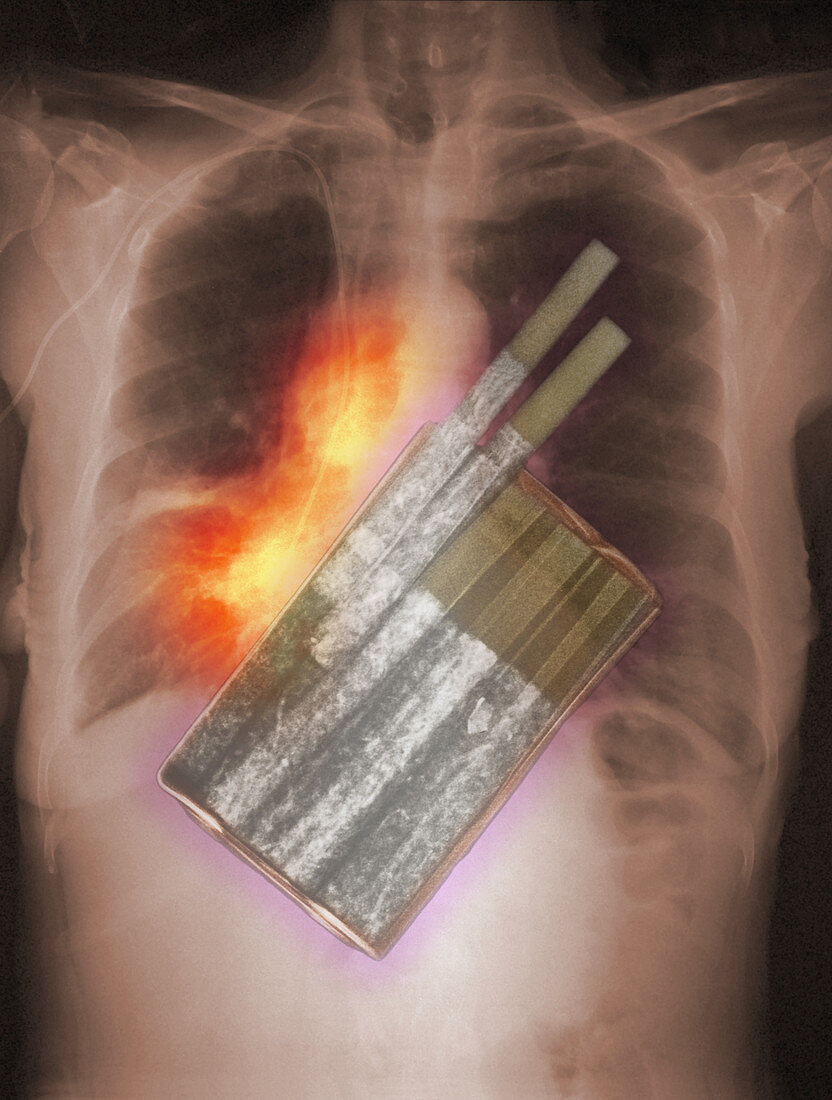 Cigarettes and Lung Cancer