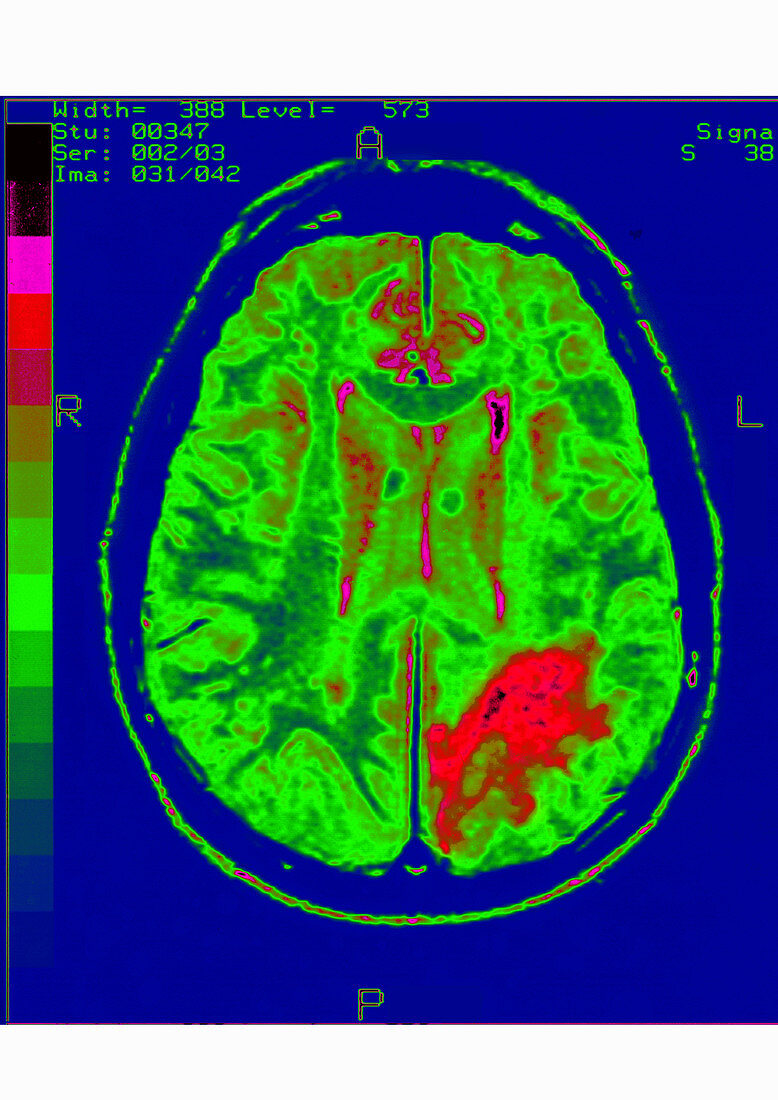 Cerebrovascular Disease