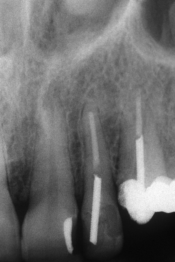 Root Canals,X-ray