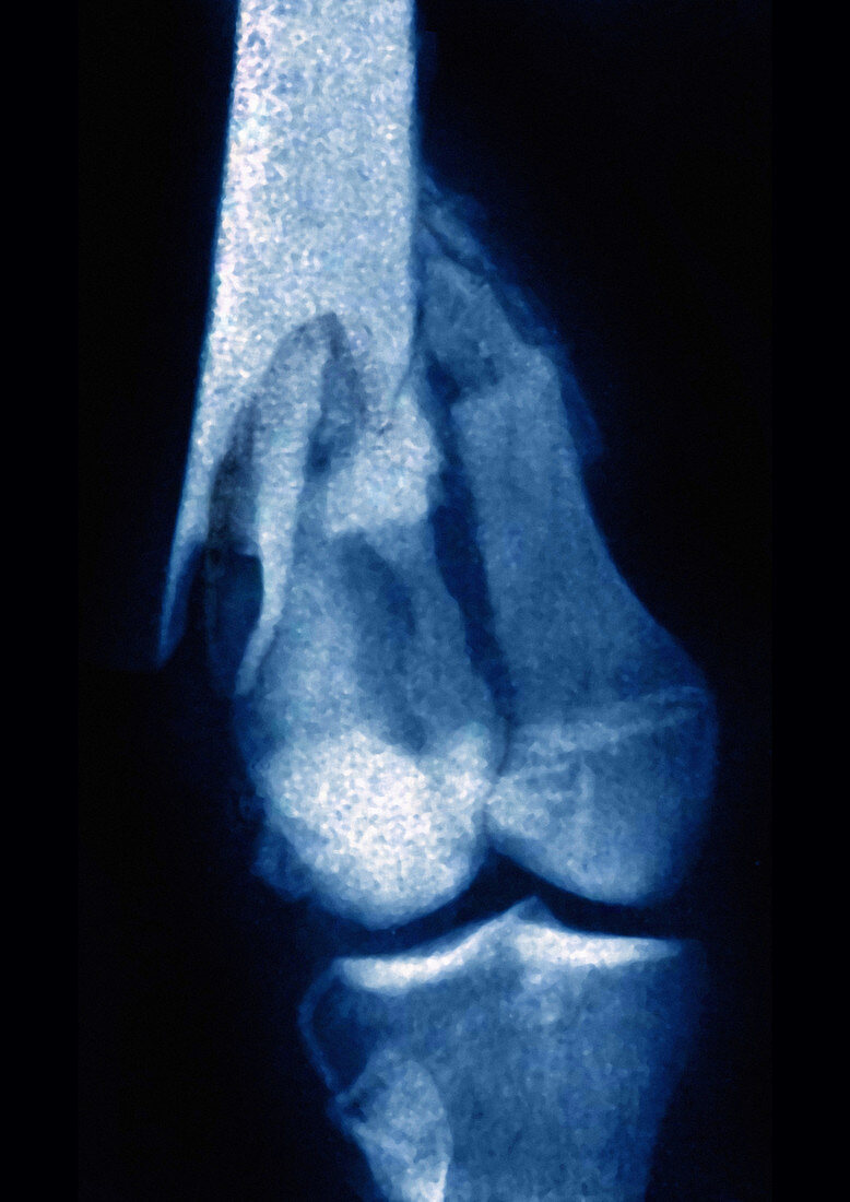 Femoral Fracture