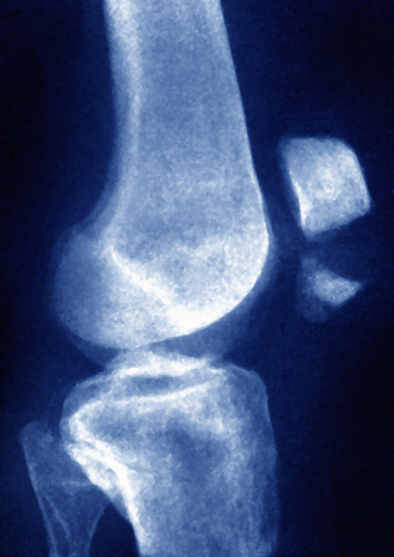 Kneecap Fracture