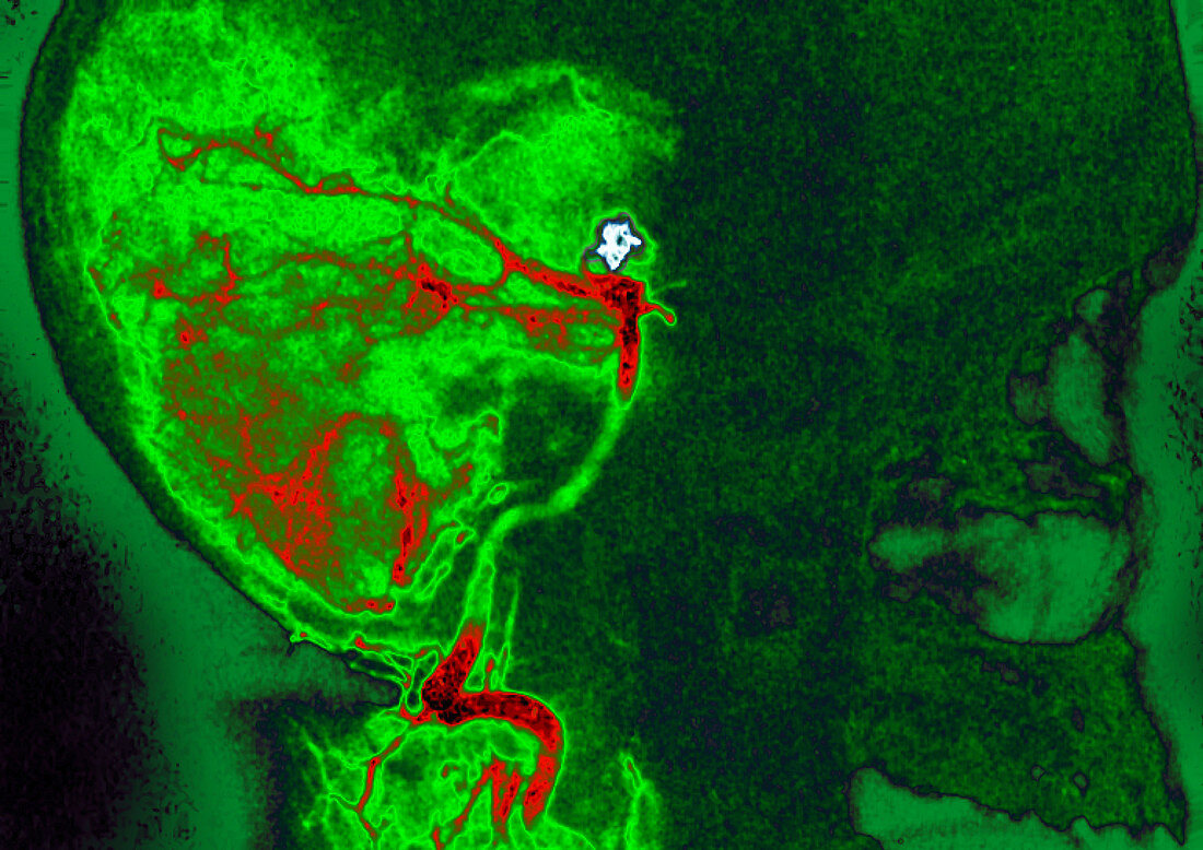 Hereditary hemorrhagic telangiectasia