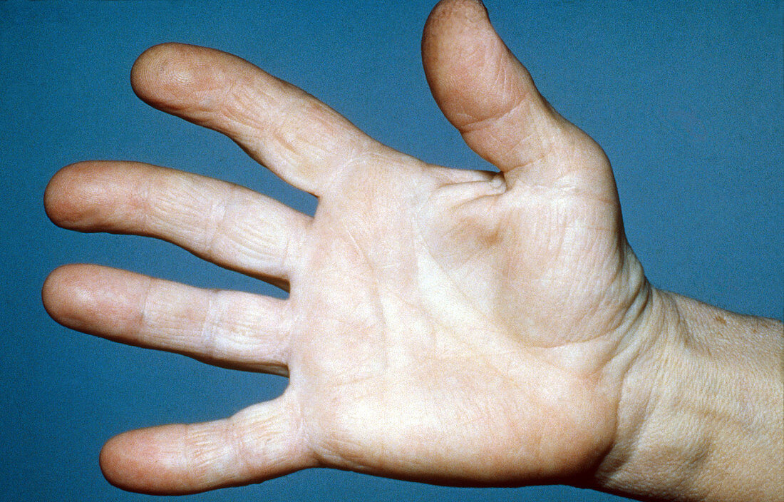 Acromegalous Hand