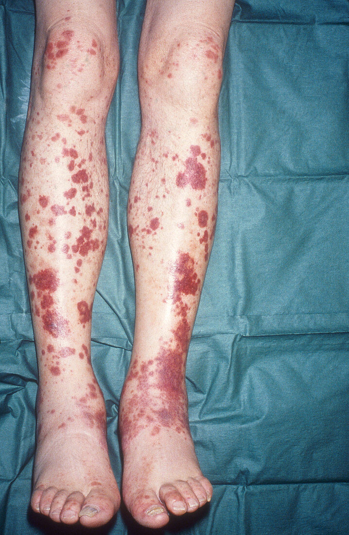 Staphylococcal endocarditis