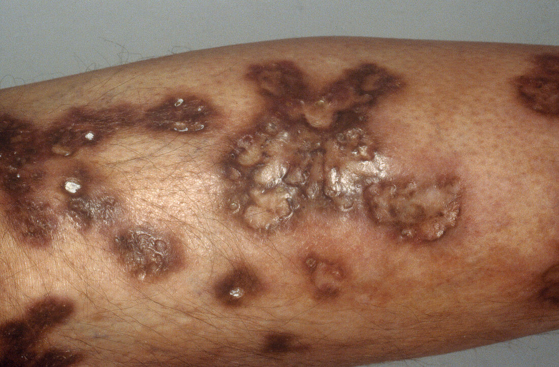 Ulcerative Sarcoidosis