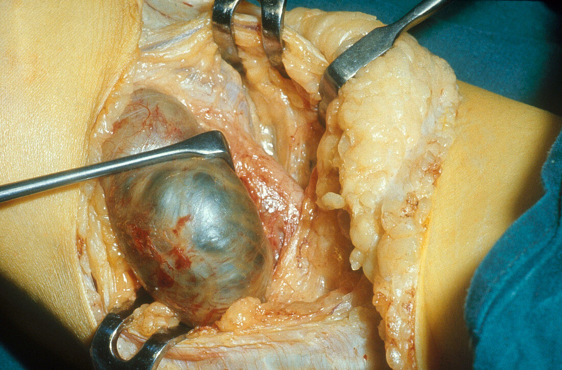 Knee,Lateral Popliteal Cyst