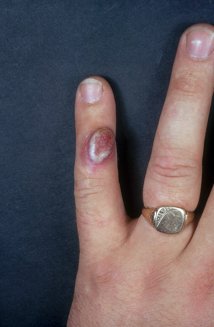 Orf Disease,Lesion on Finger