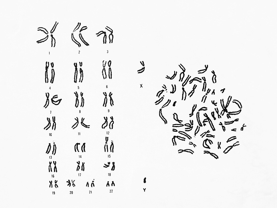 Male Karyotype showing Down's Syndrome