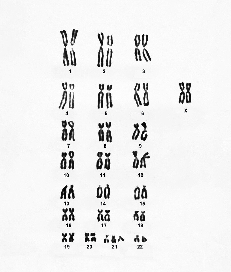 Female Karyotype showing Down's Syndrome