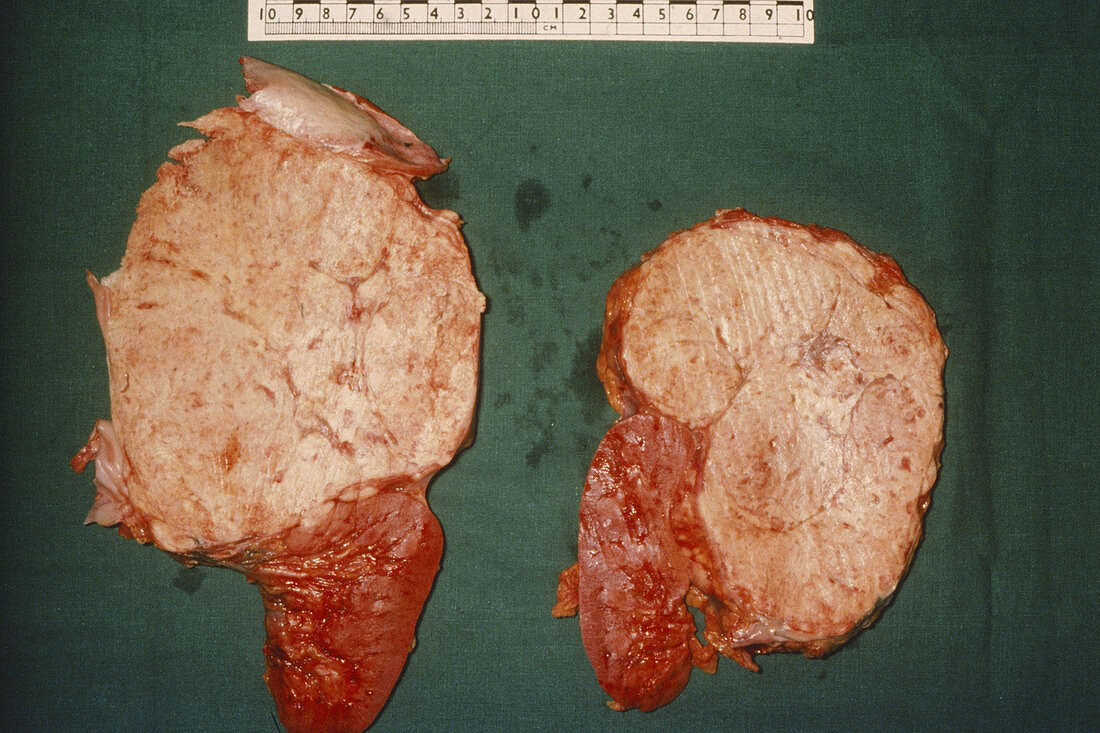 Adrenal Gland with Bilateral Cancers