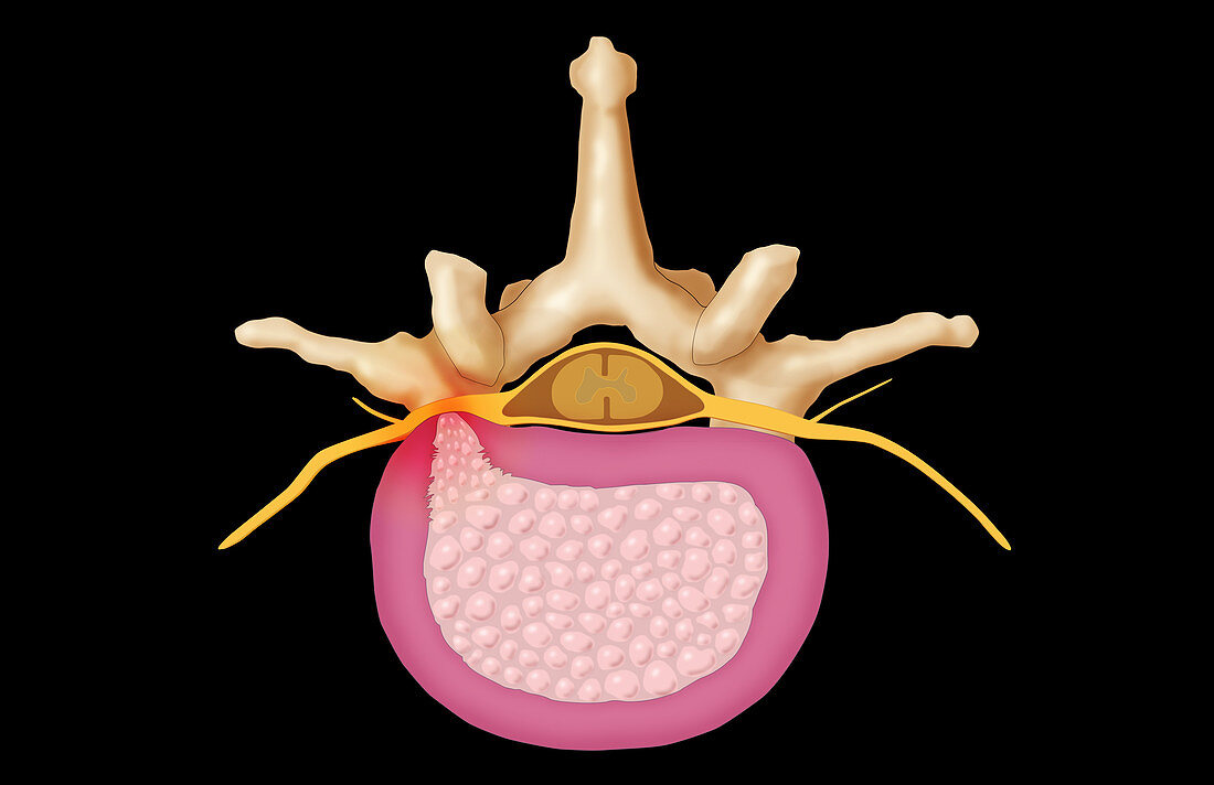 Lumbar Vertebra and Herniated Disk