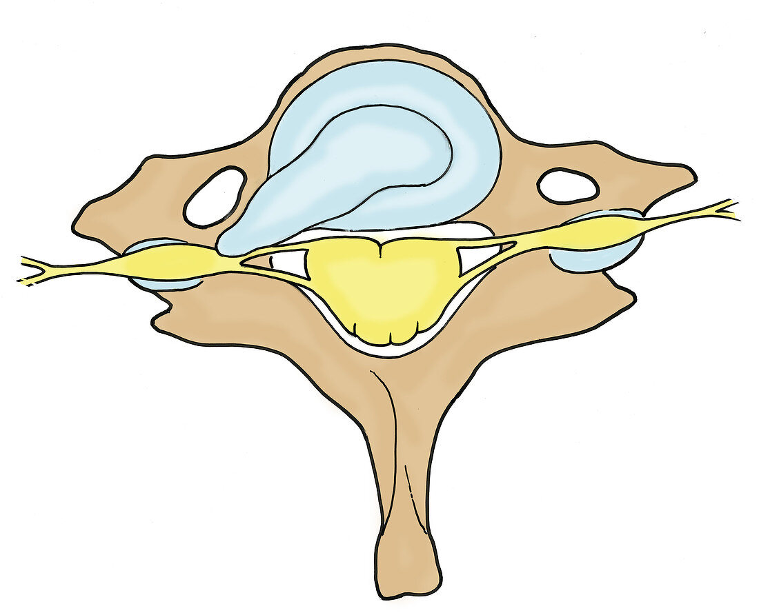 Illustration of Herniated Spinal Disk