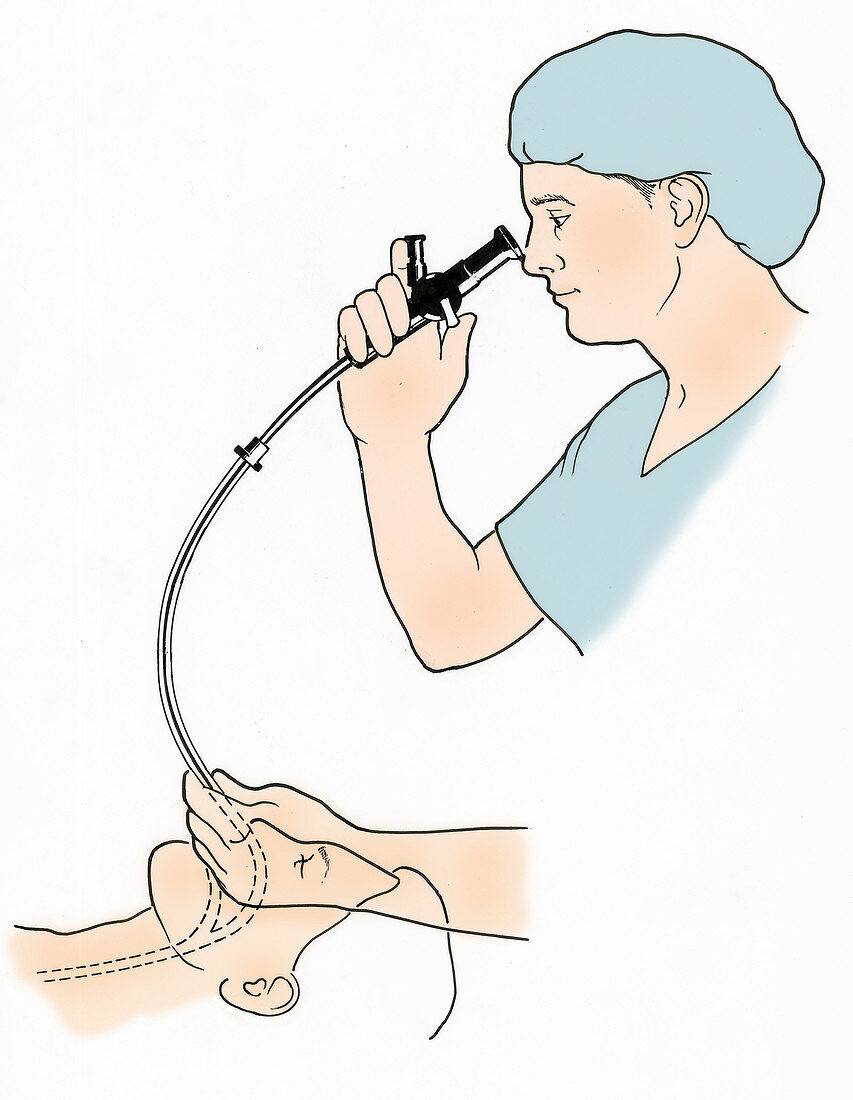 Illustration of Endoscopy