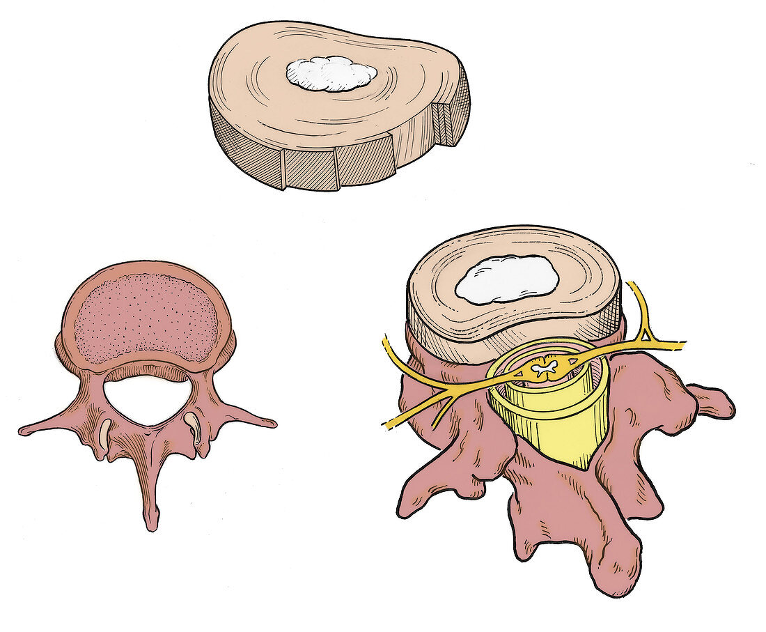 Illustration of Spinal Disks