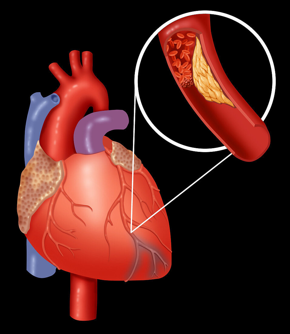 Heart Attack Showing Blood Clot